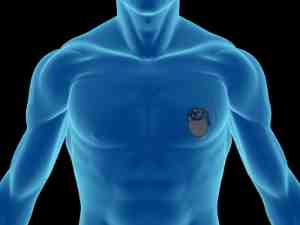 Biomedical Coatings for Implantable Medical Devices Biomedical Coatings for Implantable Medical Devices